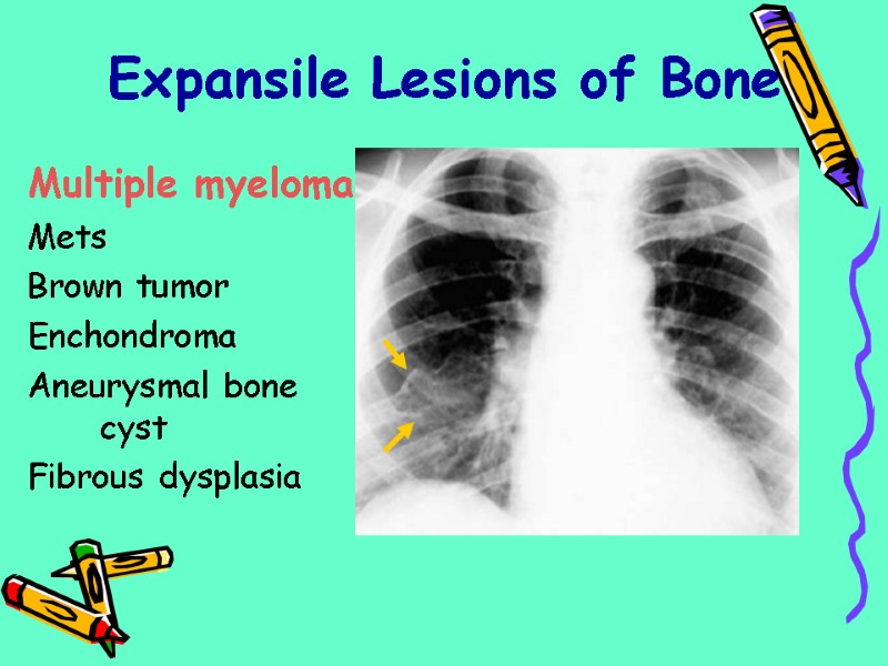 Expansile Lesions of Bone Multiple myeloma  Mets Brown tumor Enchondroma Aneurysmal bone cyst